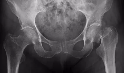La prevención y tratamiento de la osteoporosis en Cantabria